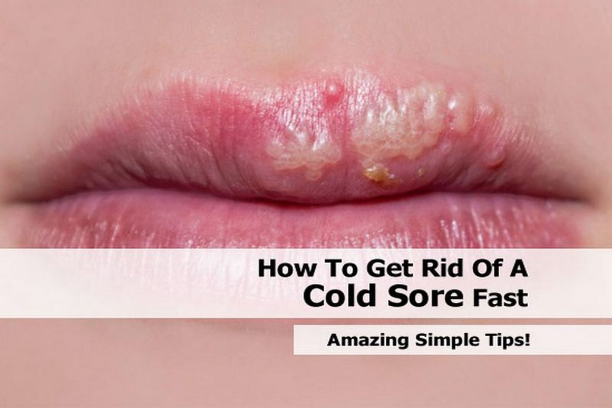 get-rid-of-cold-sore-fast.jpg